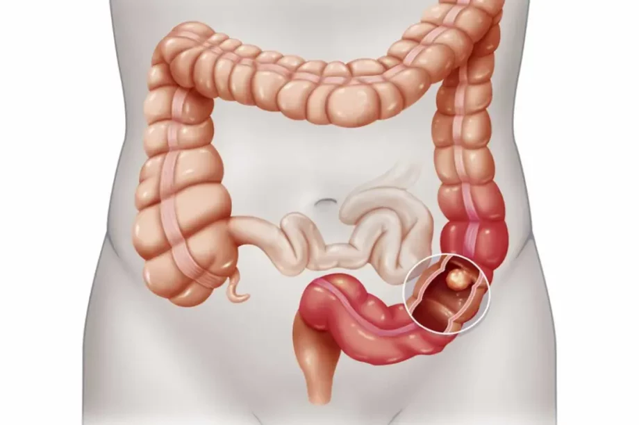 Καρκίνος παχέος εντέρου