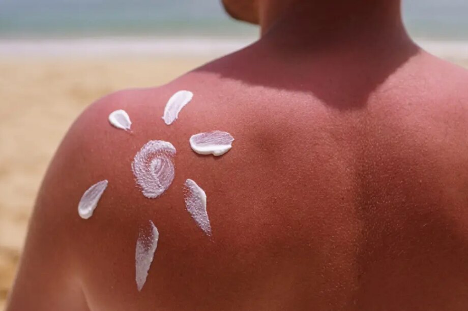 ηλιακό έγκαυμα