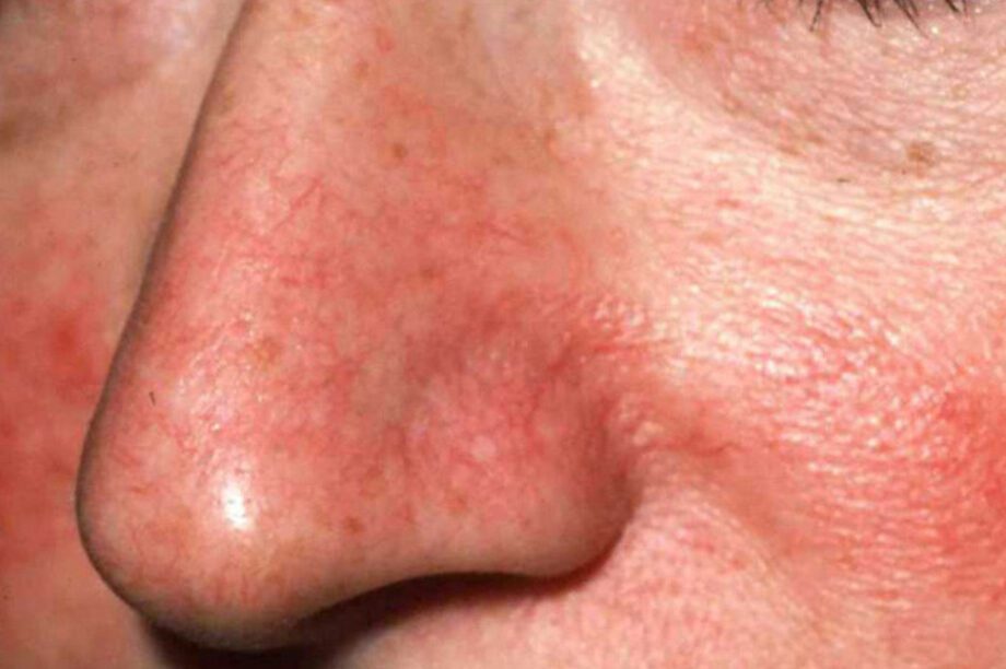 ροδόχρους ακμή