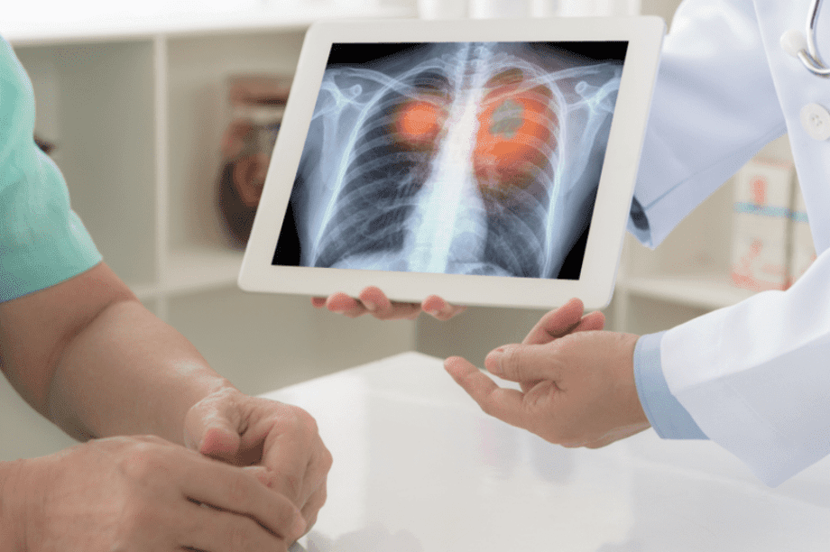 καρκίνος του πνεύμονα