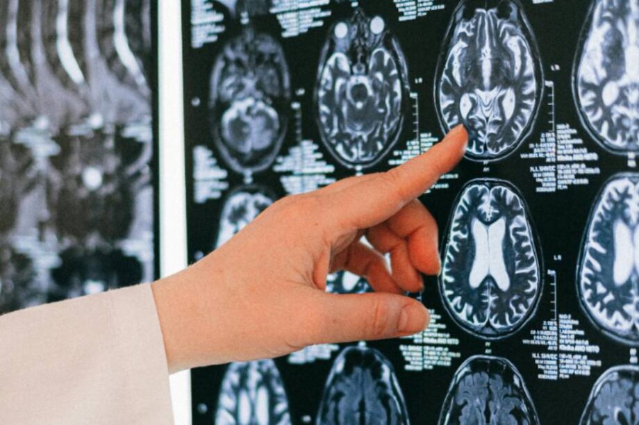 εγκέφαλος - ερευνα - μελετη - γιατροι - επιστημονες