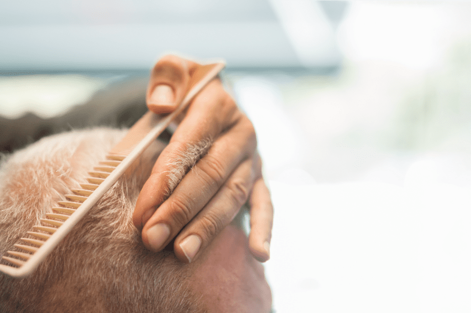 τριχόπτωση