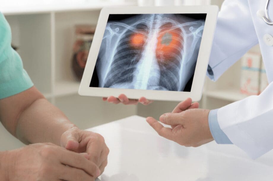 καρκίνος του πνεύμονα