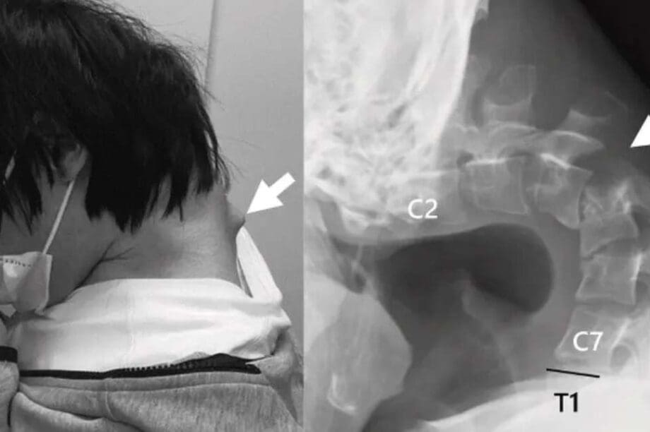 Ιάπωνας αυχένας