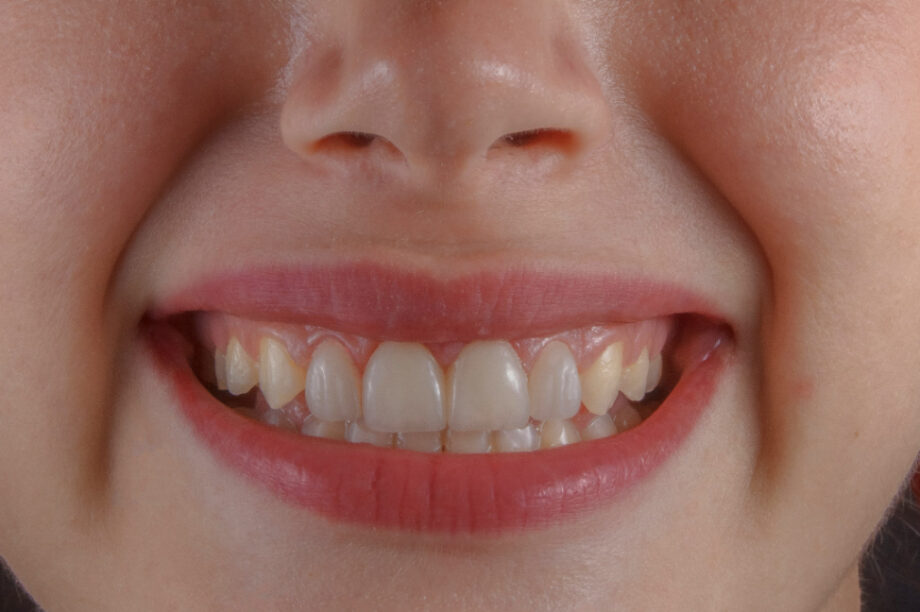 Το μεγαλύτερο πρόβλημα της στοματικής υγιεινής δεν αφορά τα δόντια!