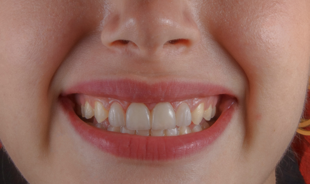 Το μεγαλύτερο πρόβλημα της στοματικής υγιεινής δεν αφορά τα δόντια!