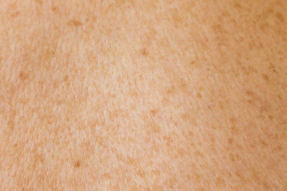 Πως ο τύπος της επιδερμίδας μπορεί να αλλάξει με την πάροδο του χρόνου